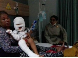 Miris! Balita Terbakar Akibat Hand Sanitizer